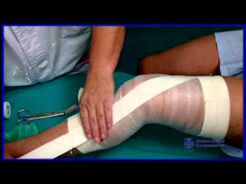 distensión ligamento cruzado anterior sintomas de diabetes