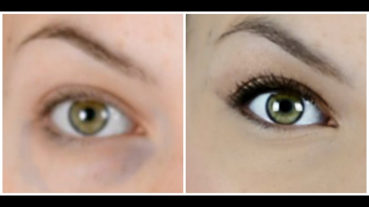 Los bolsas de como ojos las sacarte