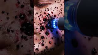 #asmr#satisfying#oddlysatisfying#shorts#ytshorts#trypophobia#extraction#cleaning#parasite