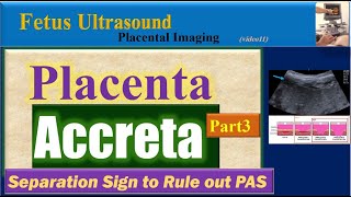 Fetus Ultrasound, Placenta Accreta Part3
