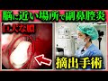 副鼻腔炎の中でも危険｜蝶形骨洞炎とは？症状・原因・手術まで耳鼻科医が解説