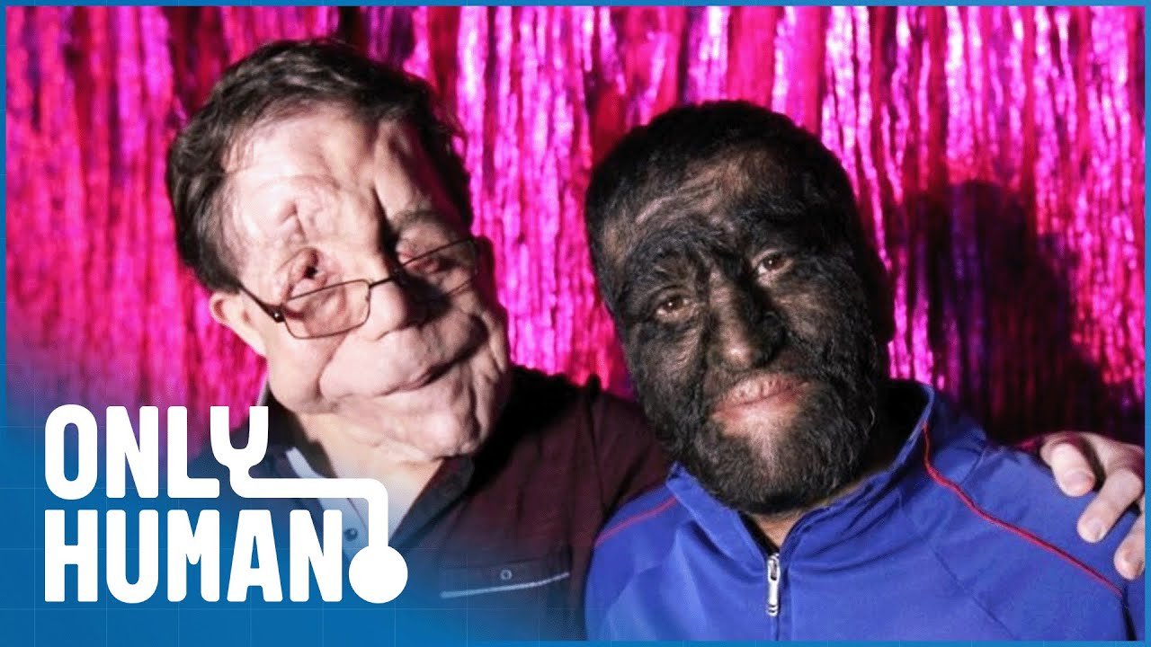 Adam Pearson: Freak Show | Using Unusual Appearances to Educate on Biological Rarities | Only Human