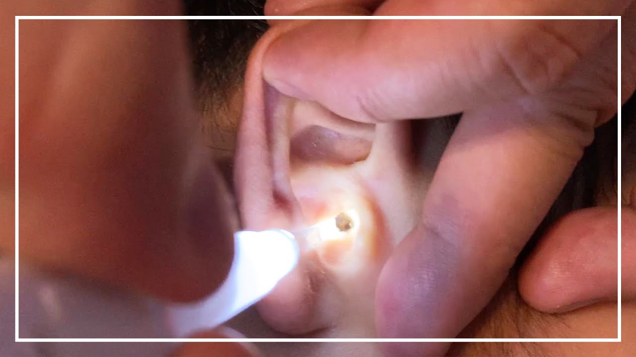 【耳かき】えにし耳が聞こえない？！まさかの耳穴にふたがされてた！【閲覧注意】