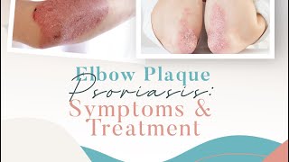 Elbow Plaque Psoriasis: Symptoms & Treatment