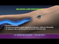 Animation of Ablación Laser Endovenosa