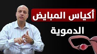 اسباب حدوث كيس دموي على المبيض وكيفية علاجه