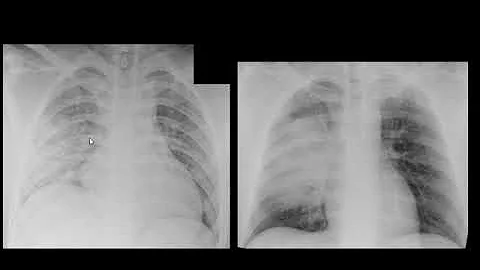O que pode causar uma contusão pulmonar?