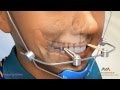 Orthodontic Treatment For Underbite Or Crossbite Facemask Or Reverse Pull Headgear