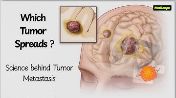 How Cancer Spreads: The Hidden Science of Metastasis Explained