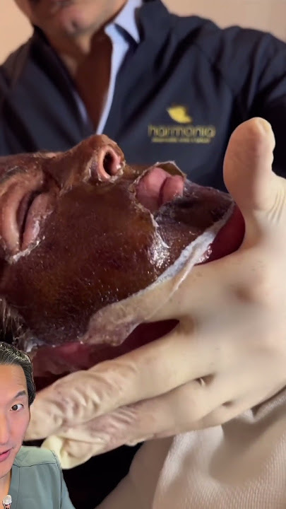 Plastic Surgeon Reacts to Phenol Peel- Would You Do This?