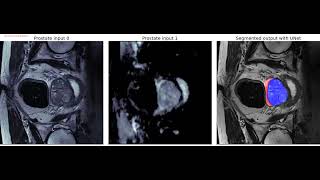 Prostate image segmentation | U-Net | python | Medical Segmentation |  Decathlon dataset