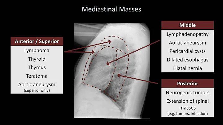 How to Interpret a Chest X-Ray (Lesson 5 - Cardiac Silhouette and Mediastinum)