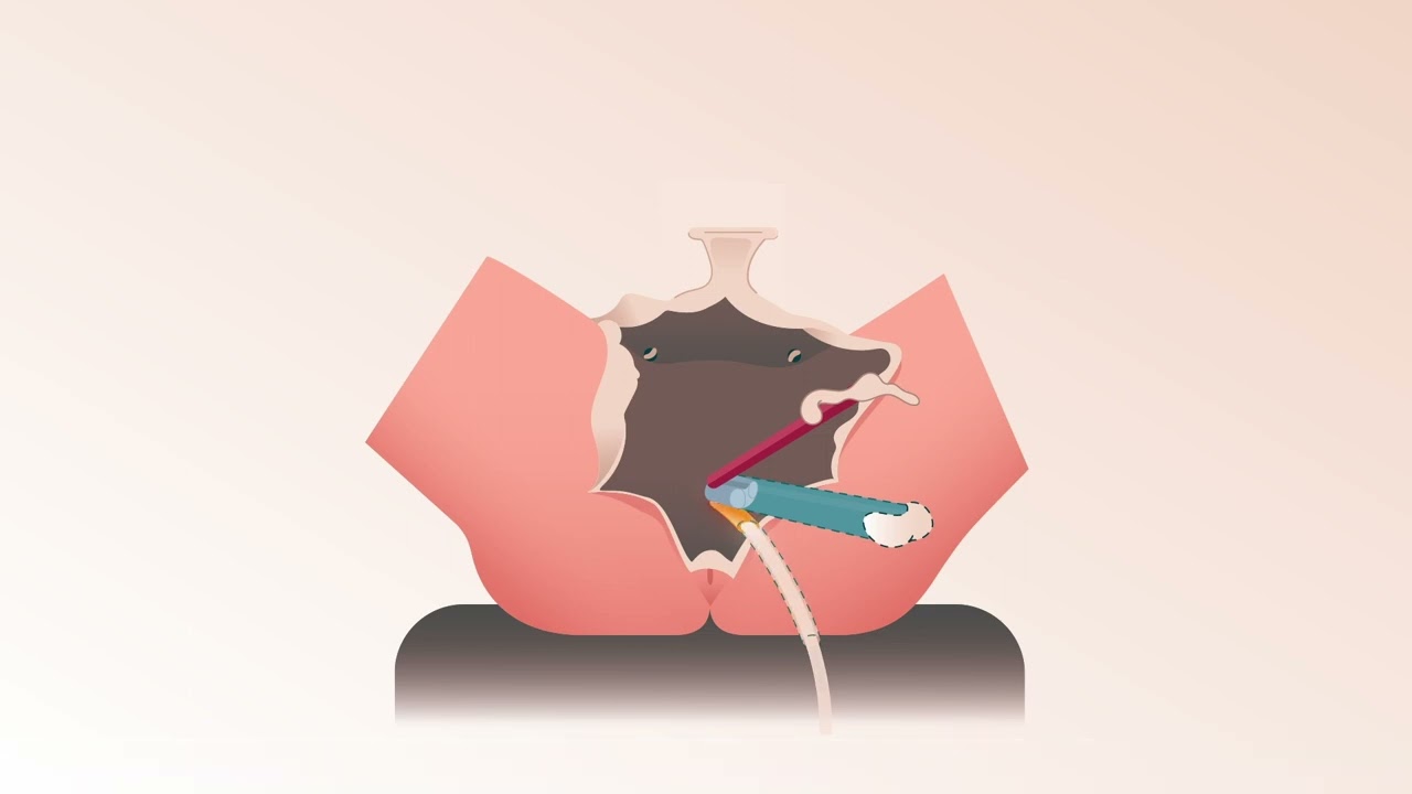 Vaginaplastiek - de operatie