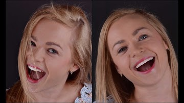 Digital Veneers Smile Design - Carestream Scanner 3600, 9600 FaceScan, Exocad & Mockup