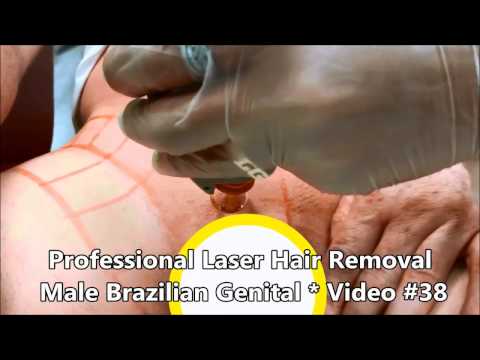 Professional Laser Hair Removal - Male Brazilian genital - Video #38