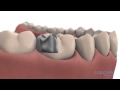 Amalgam - Lapointe dental centres