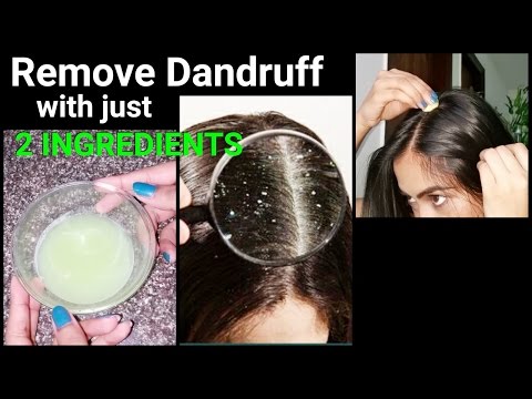 Magical Home Remedy to Remove DANDRUFF at home//Dandruff treatment/How to get rid of dandruff