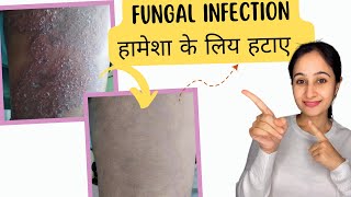 फ़ंगस इनफ़ेक्शन का इलाज|how to cure fungal infection on skin|fungal infection kya hota hai