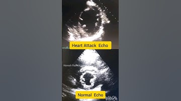 Heart Attack  Echo vs Normal  Echo  | #heart #heartattack #humanheart