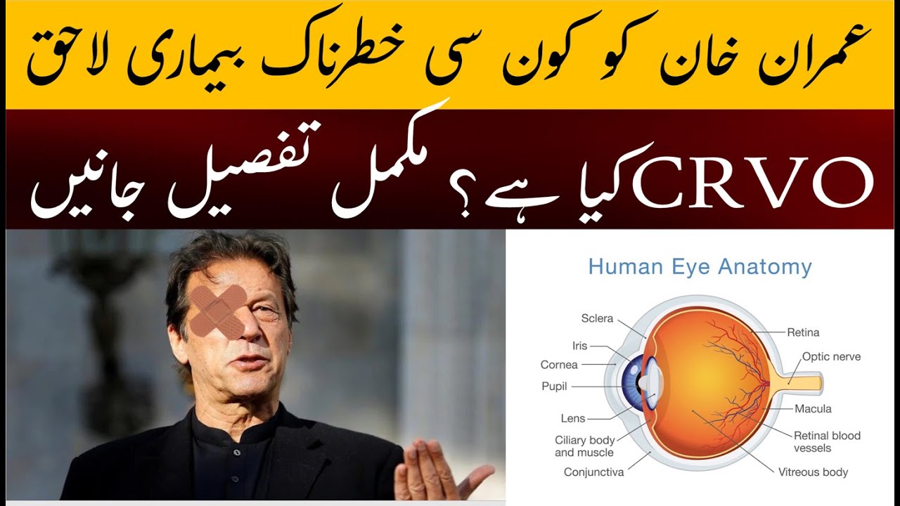 Imran Khan Eyes Infection CRVO — Mukammal Tafseel 