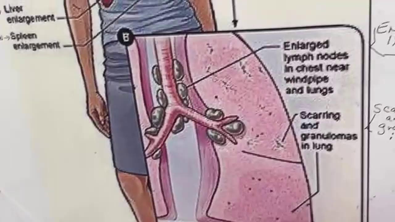 Sarcoidosis walk for the cure YouTube