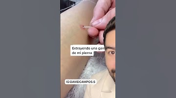 ASI RETIRAN UNA GARRAPATA