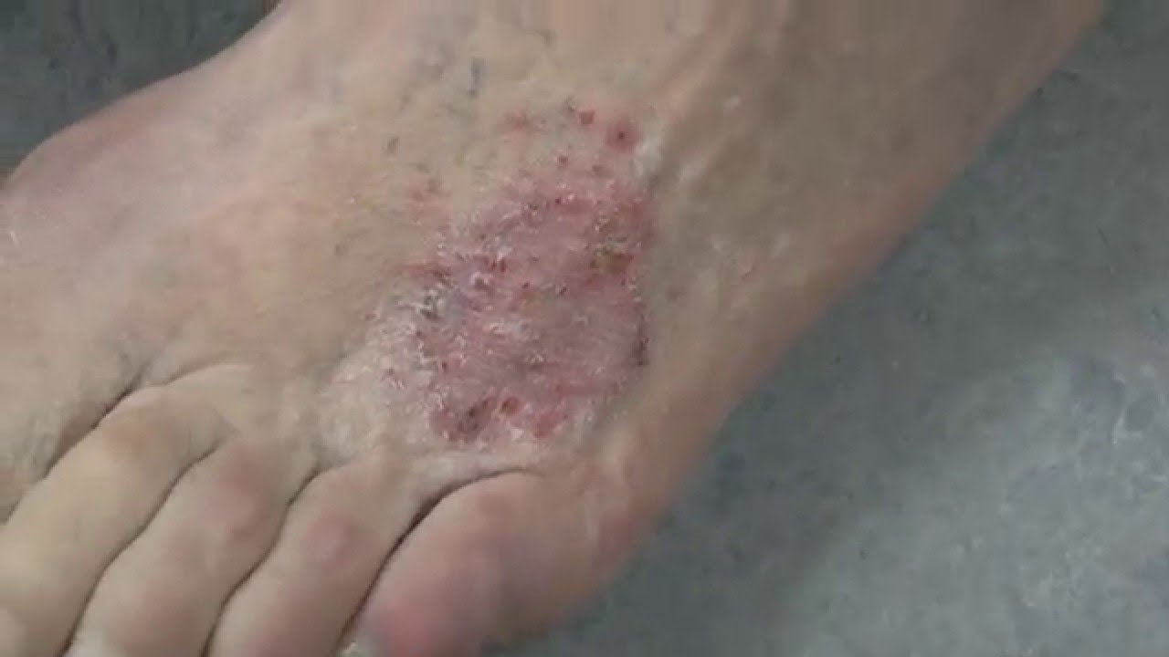 Fungal Infection On A Patients Legs Youtube