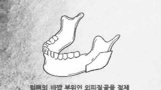 1 피질골절제술