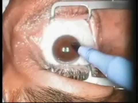 الدكتور اشرف فكري استشاري طب وجراحة العيون