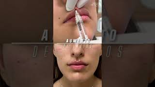Aumento De Labios Con Ácido Hialurónico