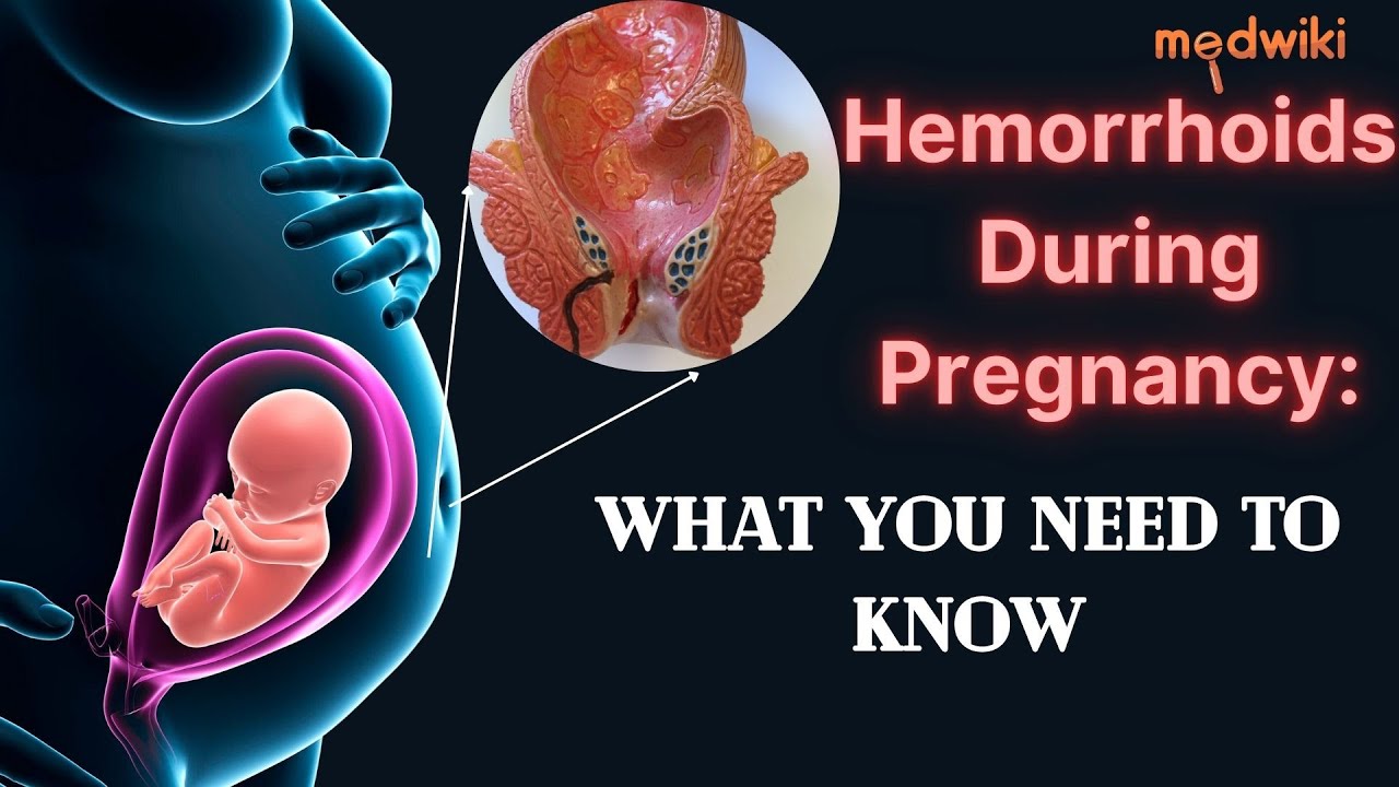 Hemorrhoids During Pregnancy: What You Need to Know - YouTube