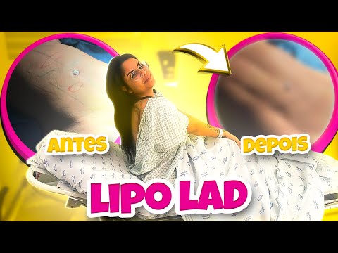 CHEGOU O GRANDE DIA!! FIZ A LIPO LAD + ANTES E DEPOIS 🔥 - YouTube
