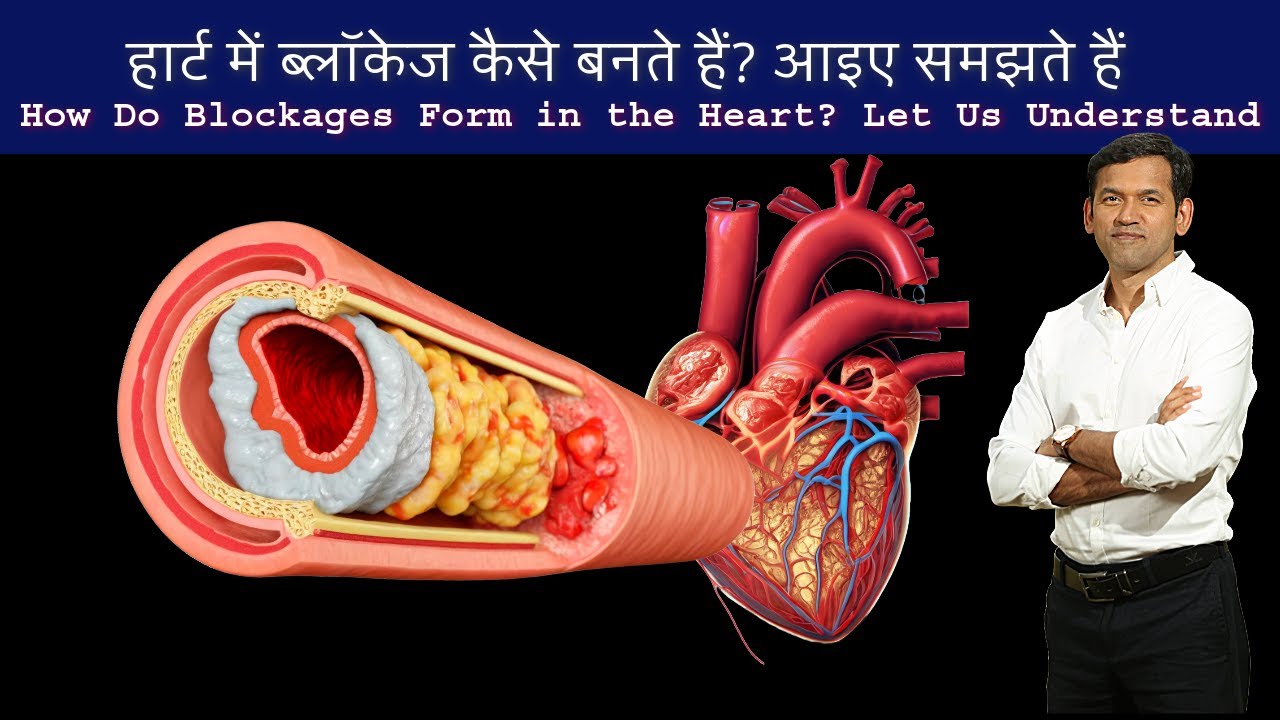 How Do Blockages Form how-do-blockages-form