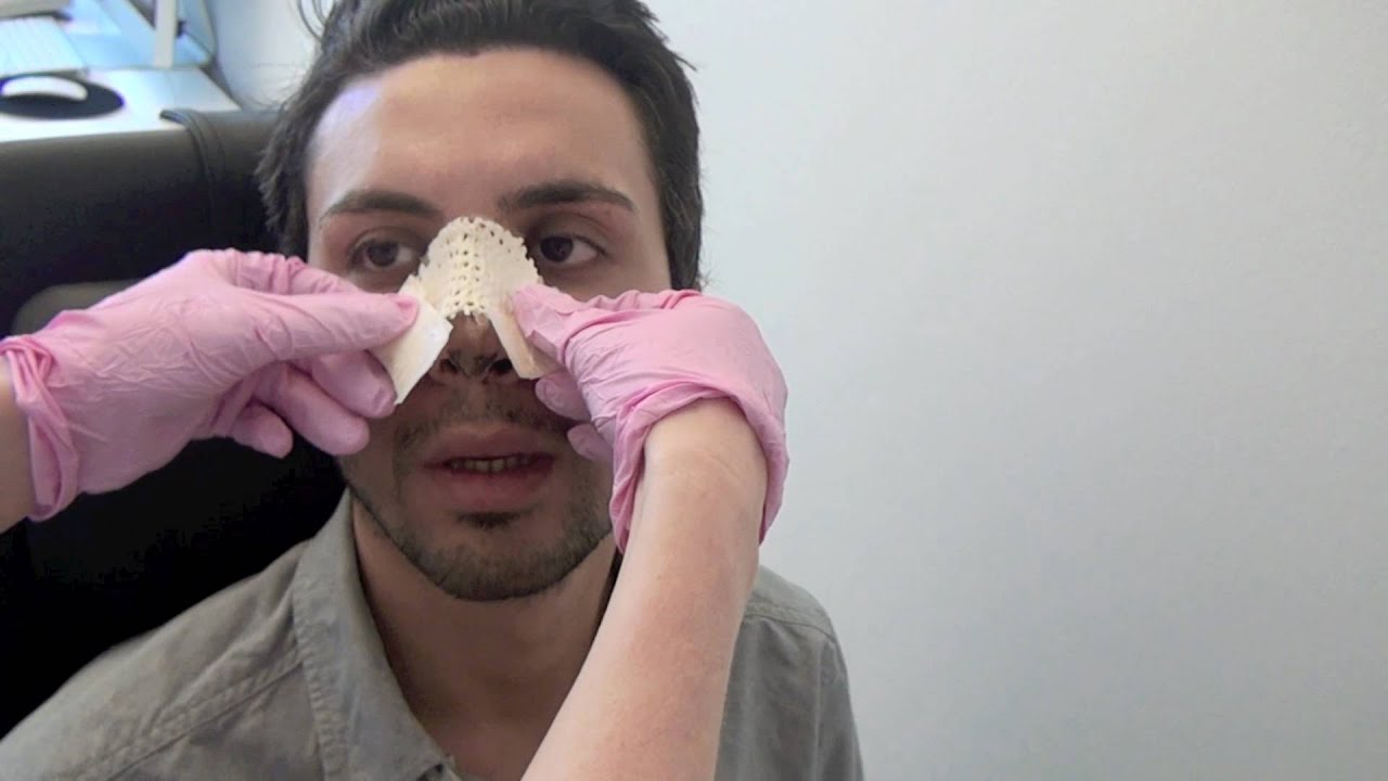 Näsplastik 26 en vecka Primakliniken Rhinoplasty