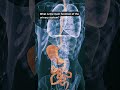 The main function of the urinary system?#UrinarySystem #Kidneys#RenalSystem #sciencefather