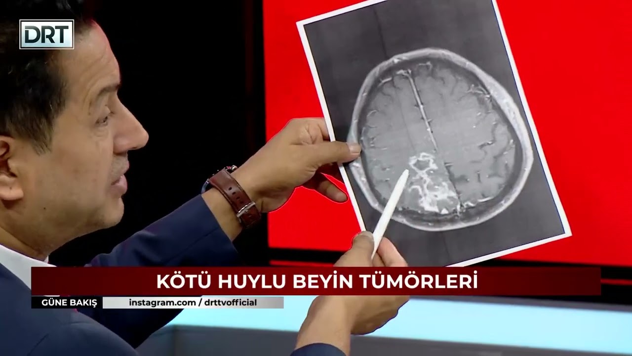 Beyin Tümörleri Belirtileri ve Tedavi Yöntemleri - Op. Dr. Muhammet İbrahimoğlu