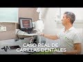 Antes y después Carillas Dentales - Clínica Silmidental