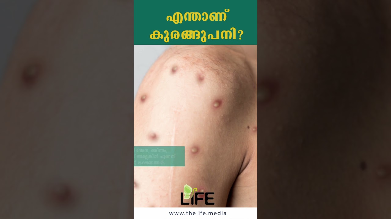 എന്താണ് കുരങ്ങുപനി? | Mpox (Monkeypox): Causes, Symptoms, Treatment | Malayalam Health Channel