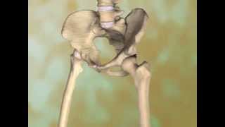 Osteoarthritis of the Hip
