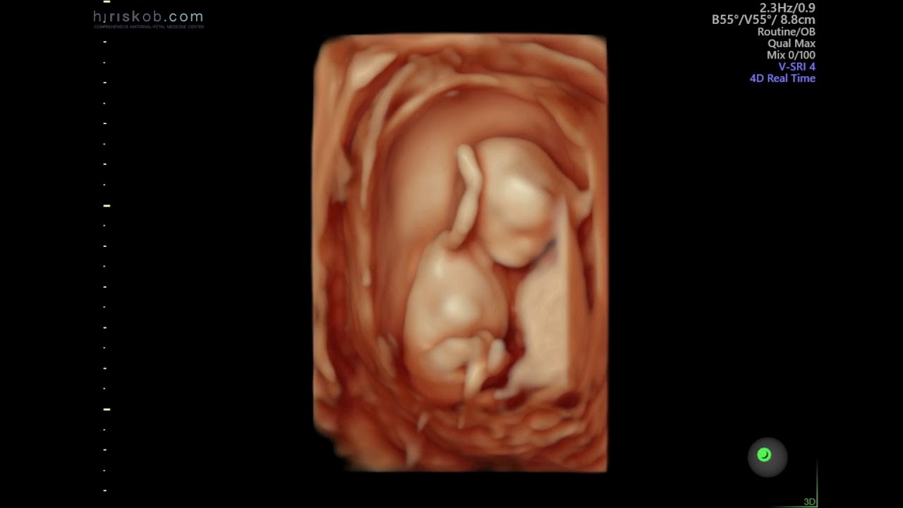 Baby Hallak 3 3d 4d Ultrasound At 12 Weeks Pregnant Youtube