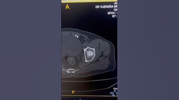 Understanding Acetabulum Fractures: A CT Imaging Guide