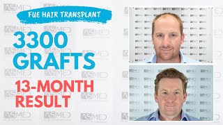 Manual FUE Hair Transplant Before & After 3300 Grafts 13-Month Result - ASMED - Dr. Koray Erdogan