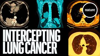 Could a pill prevent the world’s deadliest cancer?