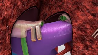 Liver Transplant Living Donor Left Lateral Hepatectomy