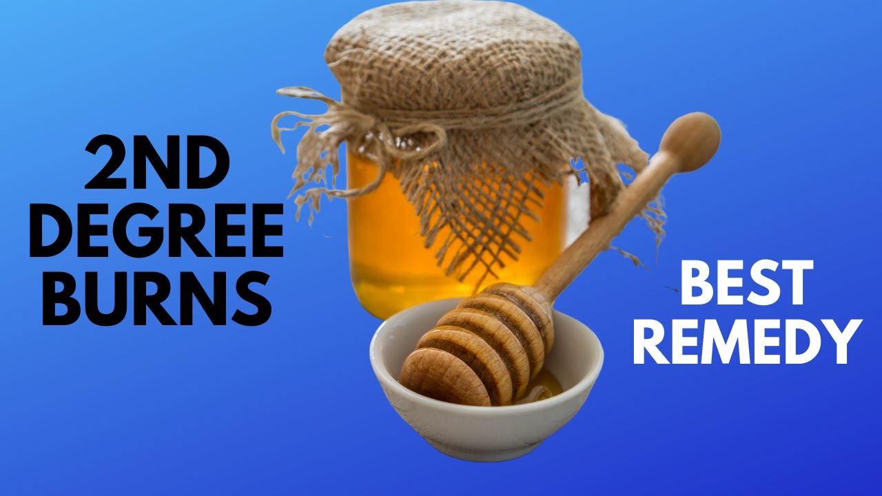 Effective Wound Care for 2nd Degree Burns - Earth Clinic's Guide