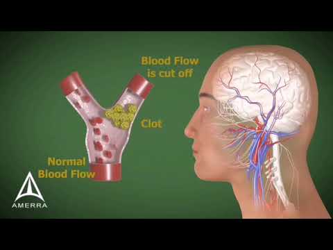 تعرف على إرتفاع ضغط الدم  HTA في خمس دقائق  من تقديم الطبيب moncef bourbia.