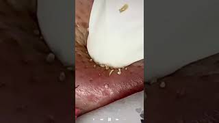 Skincare | Blackheads Removal #686 #tweezers skincare #blackheads blackheads