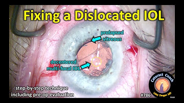 fixing a dislocated IOL (tecnis multifocal IOL)