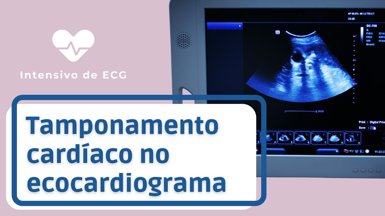 Identificando o tamponamento cardíaco no ecocardiograma YouTube