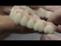 high esthetics dental implant crown / screw retained crown iso approved